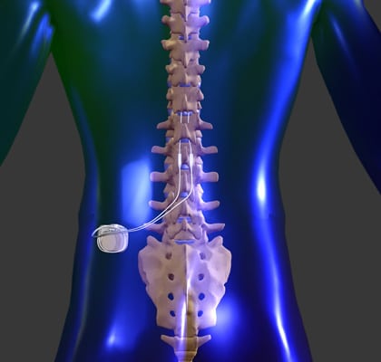 dorsal column spinal cord stimulator
